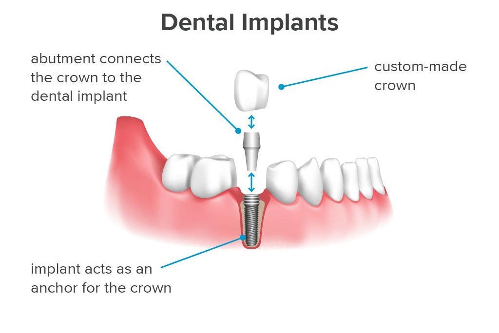 Dental Implants in Nairobi