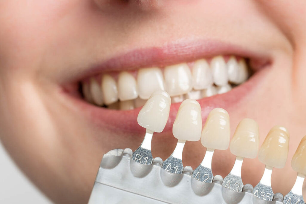 Dental implants