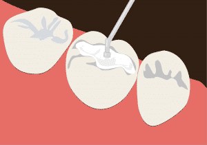 Tooth filling in Nairobi