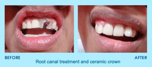 Root canal treatment in Nairobi