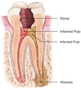 Root canal treatment in Nairobi