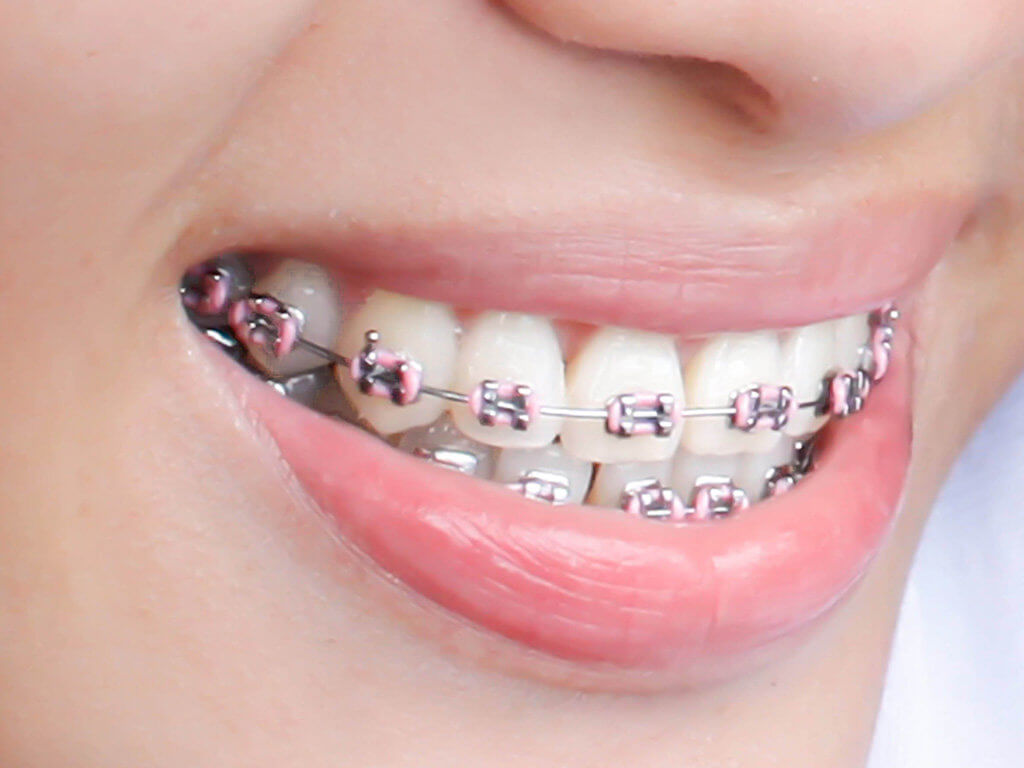 Braces in Nairobi