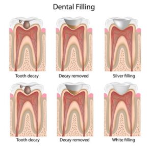 Dental Filling in Nairobi