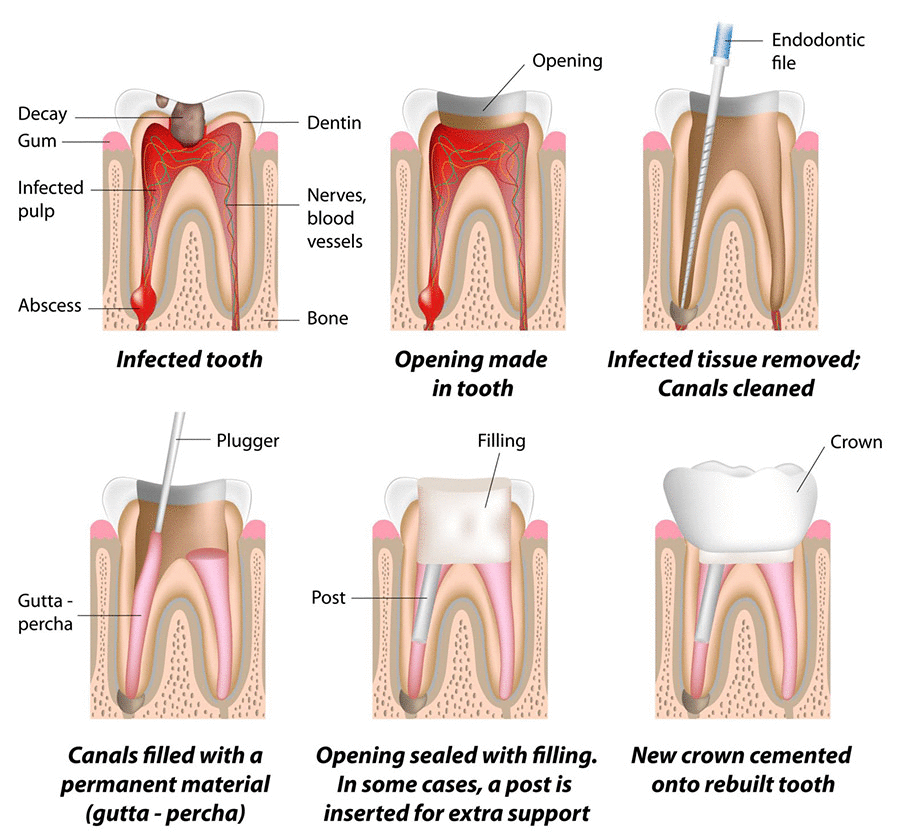 Root canal treatment in Nairobi