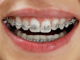 Braces