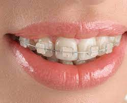 ceramic braces