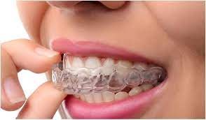 clear aligner braces