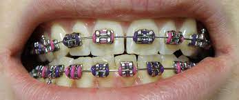 metal braces