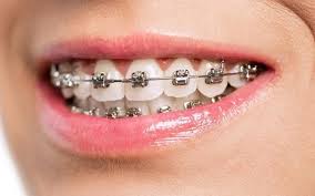 self ligating braces