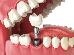 Structure of a tooth implant (benefits  of implanted dentistry)