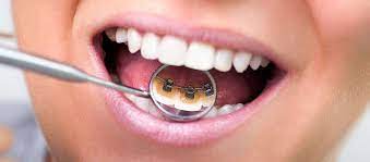 lingual braces