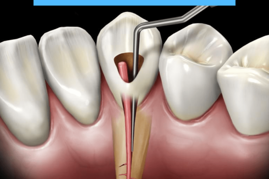 Root canal treatment