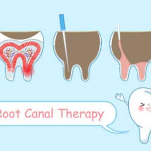 7 benefits of root canal 7 benefits of root canal