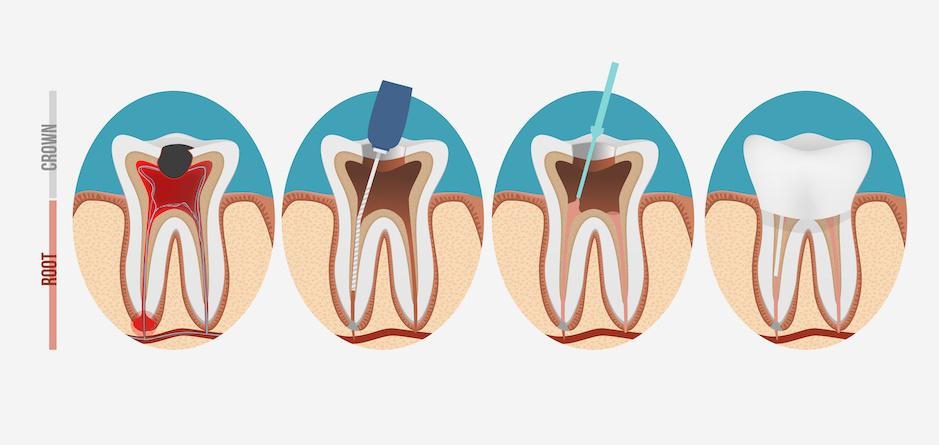 Root canal treatment 