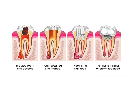 Root canal treatment