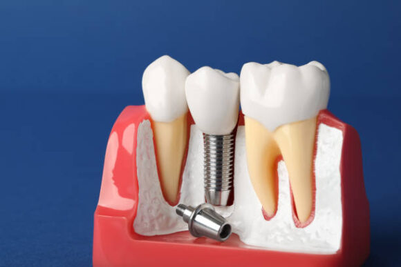 tooth-replacement-cost-in-kenya-nairobi-sterling-dental-clinic-0762