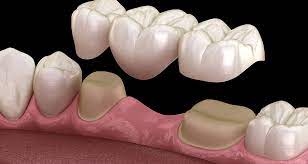 Dental bridges