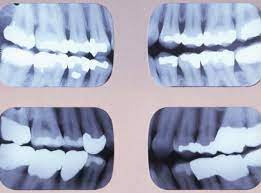 Essential Dental X-Rays: Bitewing X-rays 