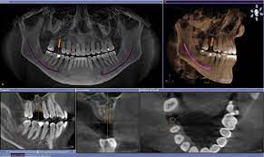 Essential Dental X-Rays: CBCT X-rays 