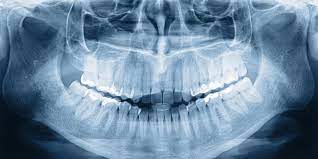 Essential Dental X-Rays: Panoramic X-rays 