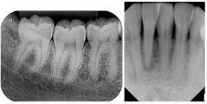 Essential Dental X-Rays: Periapical X-rays 