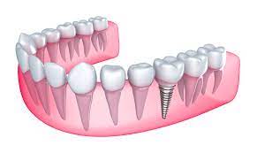 reasons why you need dental implants