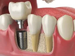 Unlocking the Secrets of Dental Implants: Step by Step