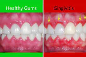 6 Common Dental Issues and How to Fix Them: gum disease 