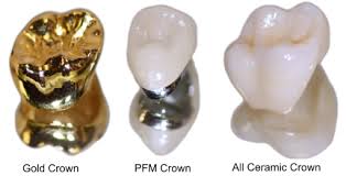 Is Your Smile Giving You the Blues? Affordable Dental Crowns in a Comfortable Setting