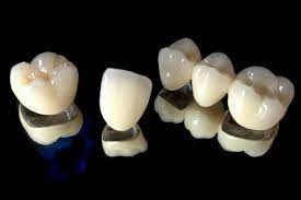 What's Your Crown Type? Exploring Different Dental Crowns and Their Respective Uses: PFM crowns