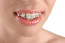 Understanding the Cost of Teeth Braces