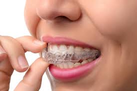 Understanding the Cost of Teeth Braces