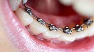 Understanding the Cost of Teeth Braces