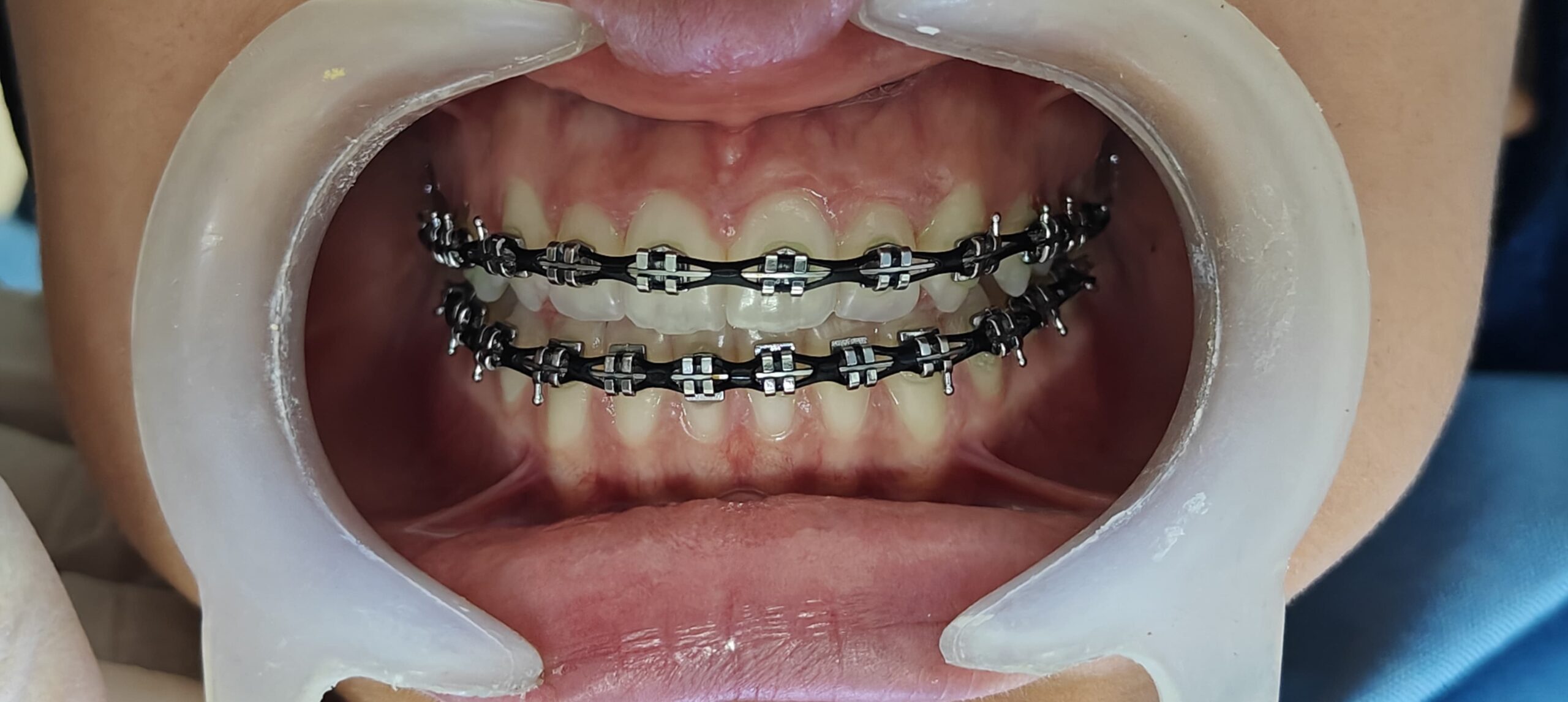 FAQs braces 