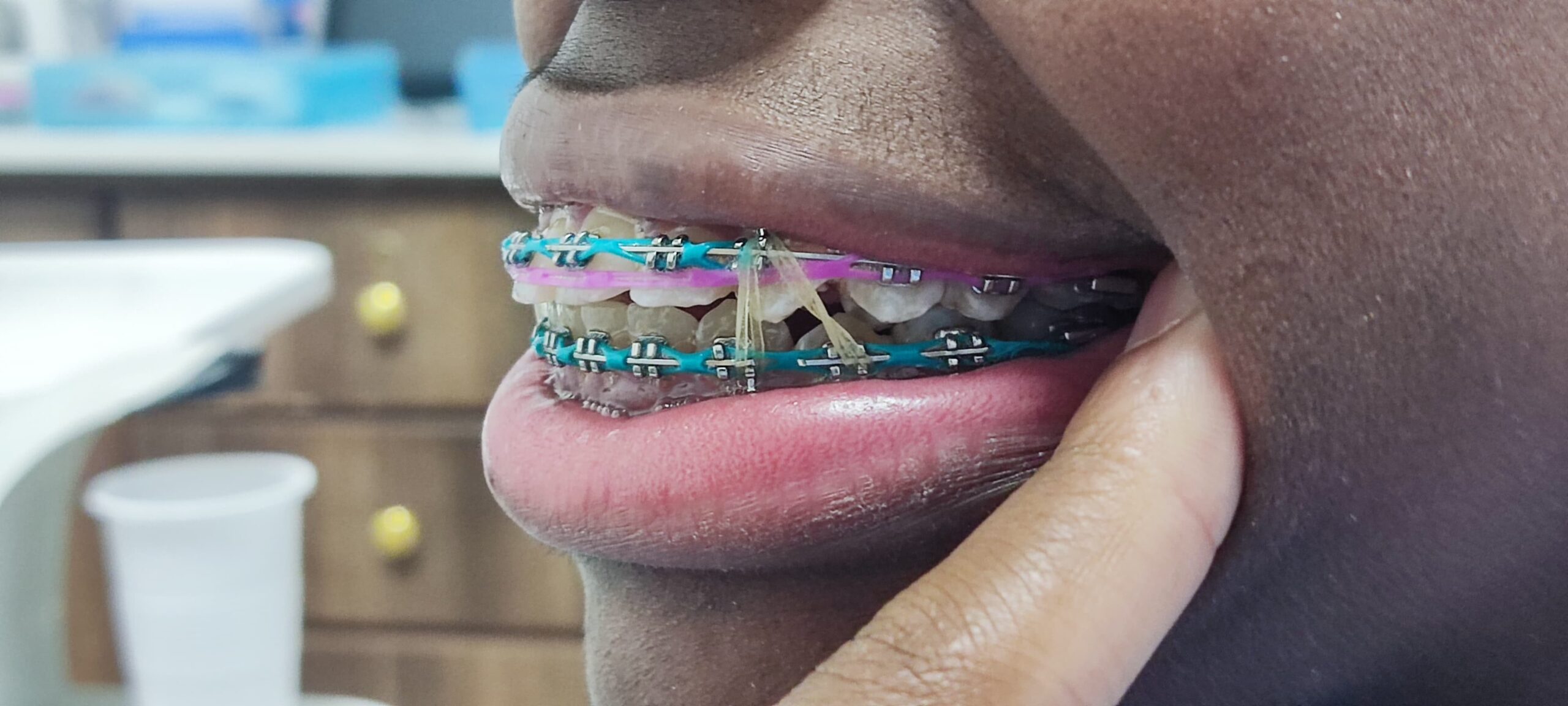 Braces payment plans Nairobi Sterling Dental Clinic