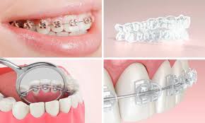 A Guide to Braces and Their Costs - Orthodontic Treatment