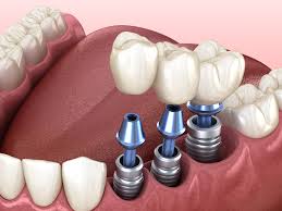 The Ultimate Guide to Tooth Implants