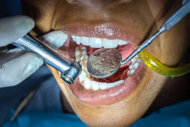 Dental Fillings Cost Dental Fillings Cost