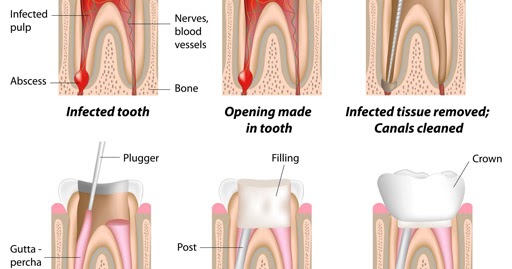 Root Canal Treatment