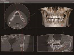 Dental X-rays cost