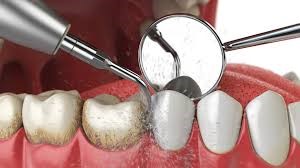 The Importance of Teeth Cleaning and Costs