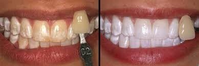 Professional Teeth Whitening