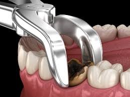 Cost of Tooth Extraction