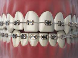 Are braces painful?