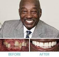 Dental Implants Cost in Kenya