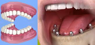 The Complete Guide to Dental Implants.