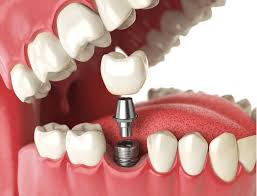 A Beginner’s Guide to Dental Implants: Are They Right for You?
