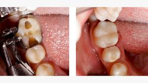 Understanding the Different Types of Dental Fillings: Which is Best for You? composite resins fillings 
