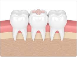 Understanding the Different Types of Dental Fillings: Which is Best for You? glass ionomer fillings 
