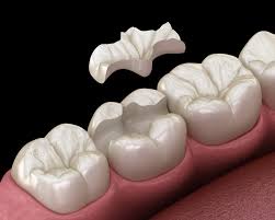 Understanding the Different Types of Dental Fillings: Which is Best for You? porcelain fillings 
